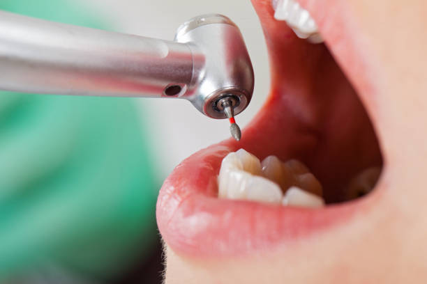 Best Emergency Root Canal Treatment in Dale, IN